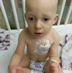 Young child with chemotherapy port in chest